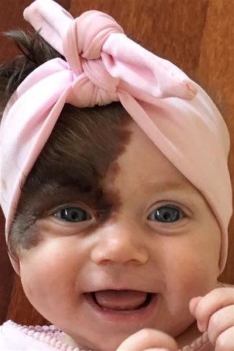 Baby Set To Undergo 7 Operations To Remove Large Hairy Birthmark On Face | Beautiful children ...