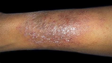 Dry skin patches: Causes, symptoms, diagnosis, and treatments