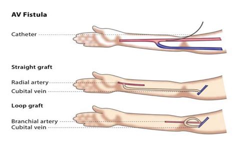 Arterio-Venous Fistula (AVF) creation for Haemodialysis - Cairns Vascular Clinic