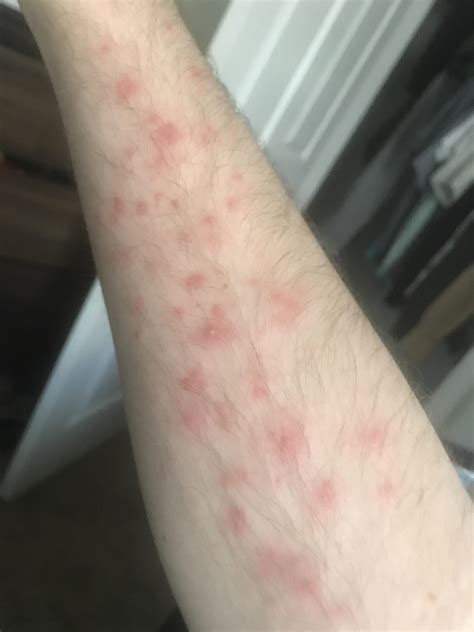 Rash on forearm day after my first jiu-jitsu session, need help identifying : r/jiujitsu