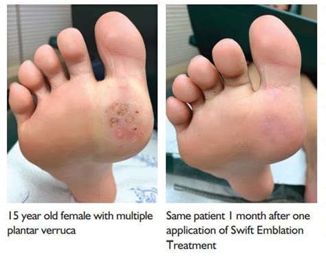 A Painless, Efficient New Treatment for Plantar Warts