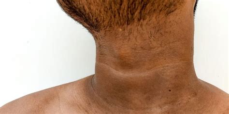 Dark Neck Symptoms, Causes, Treatment, Cost and Tips to Avoid