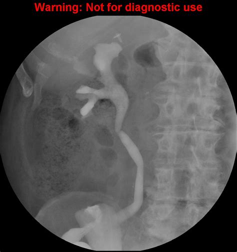 Ureteroileal anastomotic stricture (ileal conduit) | Image | Radiopaedia.org