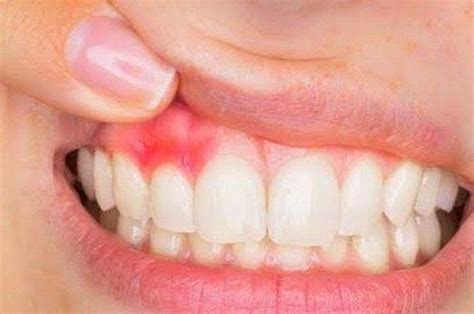 4 Causes of Canker sores on the gums and natural remedies whose ...