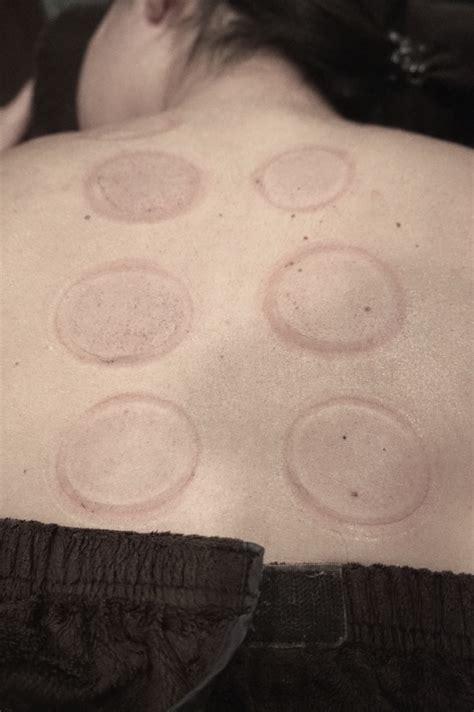 I Tried Cupping Here's What Happened - Babeskills