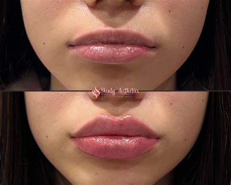 Russian Lip Filler Before & After Results - Skinly Aesthetics