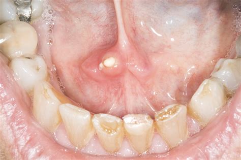 Salivary gland stones - NHS