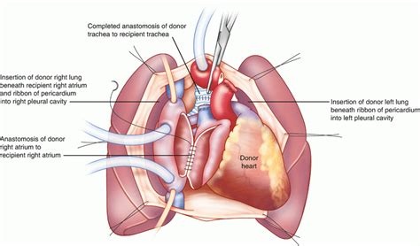 Surgical Techniques of Heart Transplantation and Heart–Lung Transplantation | Anesthesia Key