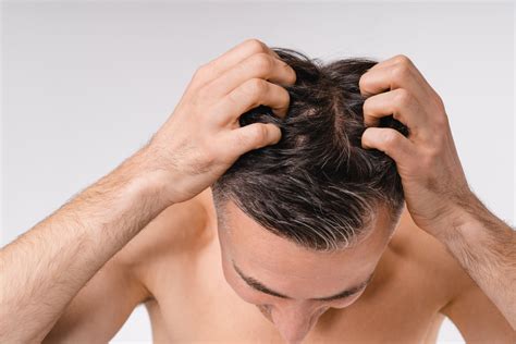 Scalp Scabs: Causes, Treatments, When to See a Doctor and More