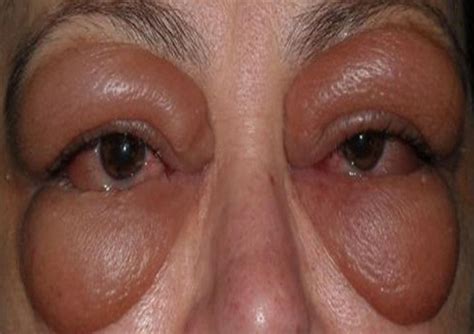 Severe eyelid oedema in Graves’ ophthalmopathy | BMJ Case Reports