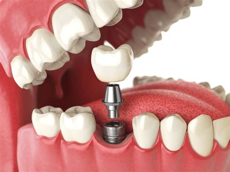 New Dental Implant Materials at williamjroebuck blog