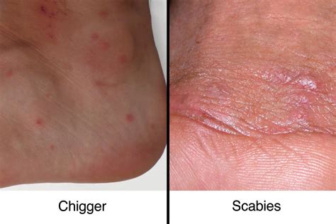 Here’s How to Tell If You Have Chigger Bites or Scabies
