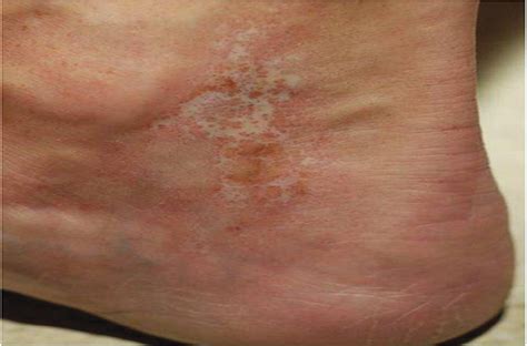 Successful Treatment of a Scleroderma-Associated Leg Ulcer W... : Dermatologic Surgery