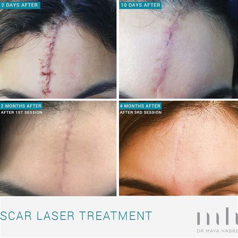 Quick Guide to Laser Scar Removal: All the Basics