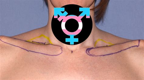 Shoulder reduction surgery latest trend in 'gender affirming care' | The Post Millennial ...