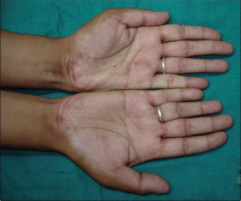 Palmoplantar fibromatosis with nail dystrophy - Indian Journal of Dermatology, Venereology and ...