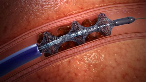 Treating Pulmonary Embolism with Inari Medical FlowTriever, a safer ...