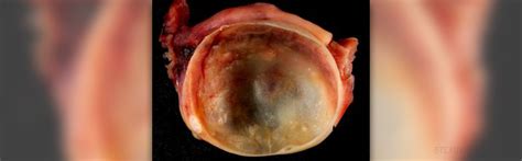 Ovarian cysts complications | General center | SteadyHealth.com