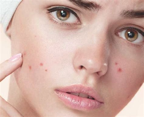 Have Acne Prone Skin? Here Are Some Things You Should Avoid Doing | HerZindagi