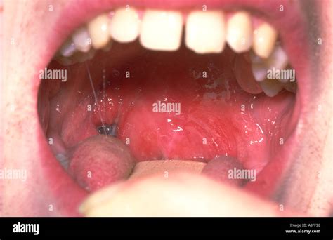 Tonsillar Abscess