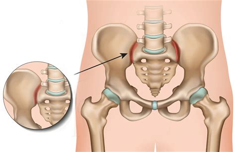 Treatment for Sacroiliac Joint Dysfunction