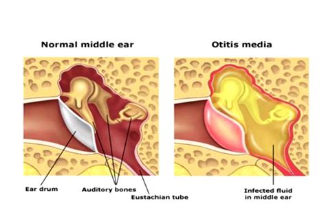 Ear Infection | Causes, Symptoms and Treatment