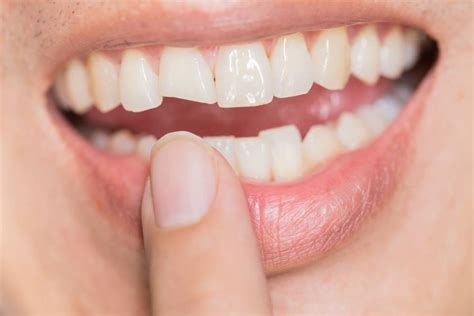 What are the causes and treatments of loose teeth in adults?