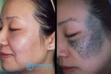 How Can You Remove Birthmarks from Face?