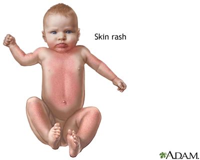 Rubella Rash