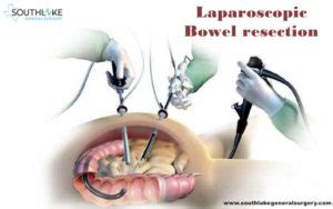 Bowel resection- Why is required? - Recovery Post Surgery - Southlake ...