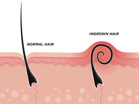 INGROWN HAIR REMOVAL KIT THAT WORKS - Body4Real