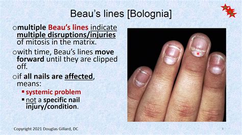 Dermatology: (Wk9)(Win21): Longitudinal ridges, Beau's lines, and ...