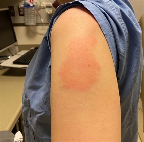 Moderna Arm Rash - Virginia man's 'skin peeled off' after J&J Covid vaccine ...