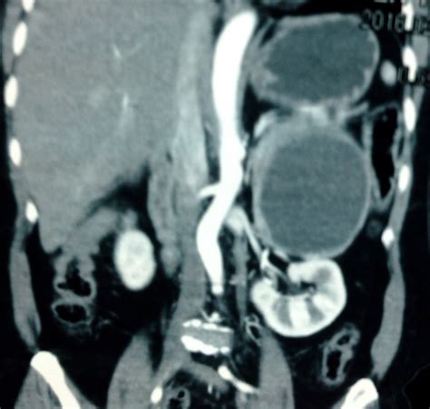 VIETNAMESE MEDIC ULTRASOUND: CASE 373: PHEOCHROMOCYTOMA, Dr PHAN THANH ...