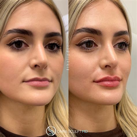 Lip Injections Before and Afters | OMNI SCULPT MD | Dallas, Texas