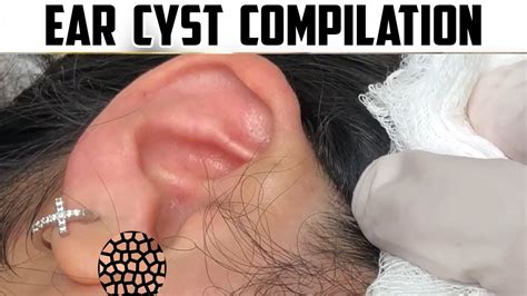 Biggest Ear Cysts of All Time with Dr. Gilmore! - YouTube