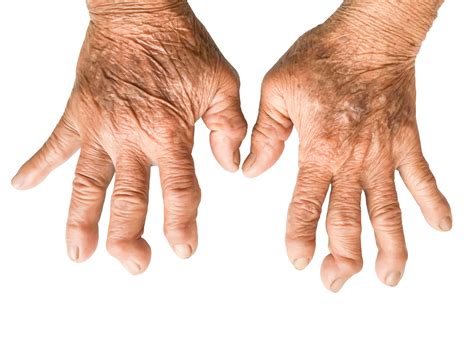rheumatoid-arthritis-adalah-penyebab-nyeri-sendi