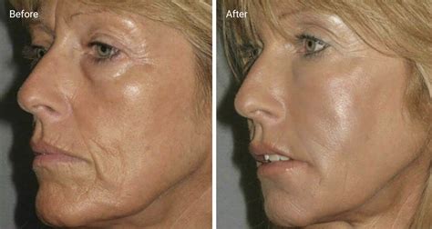 Rf Skin Resurfacing Before And After - AU SCIENCE HUB