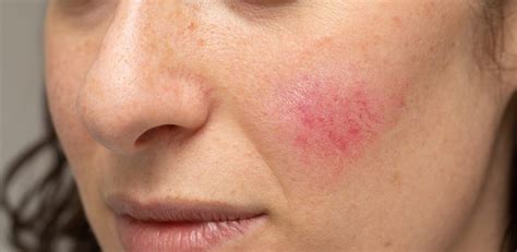 Rosacea - myDr.com.au