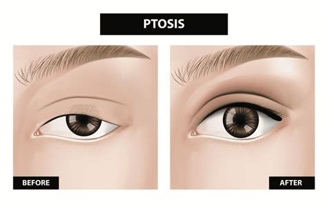 What Causes Ptosis, and How Is It Corrected?: Rand Rodgers, MD: Ophthalmic Plastic Surgeon ...