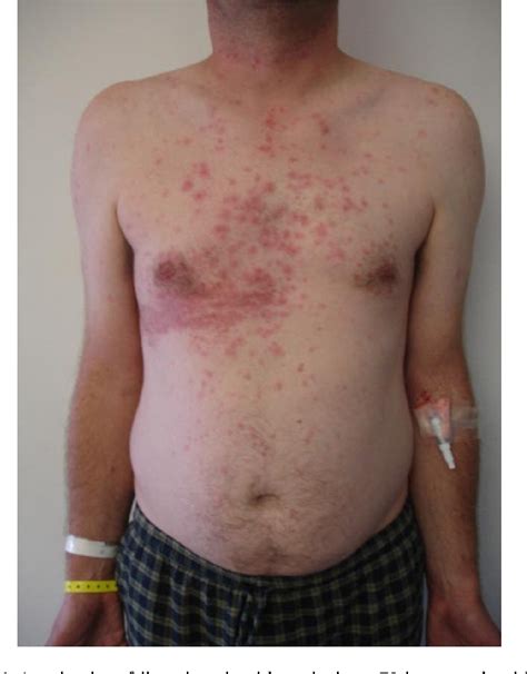 A rare case of disseminated shingles in an immunocompetent patient ...