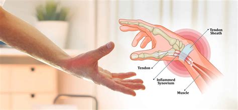 De Quervain's Tenosynovitis Thumb Pain & Painful Wrist