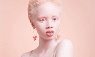 Celebrities with albinism in South Africa Archives | Online Youth Magazine | Zkhiphani.com