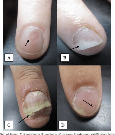 Figure 2 from Psoriatic arthritis and nail changes: exploring the ...