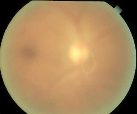 Be Aware of Weiss Ring’s Impact on pRNFL Measurements