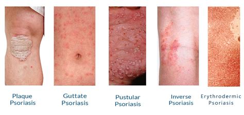 Psoriasis Treatment in Delhi: From Symptoms to Treatment | ClinicSpots