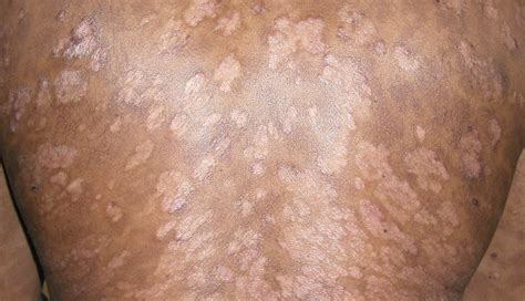 Guttate Psoriasis: Causes, Symptoms, and Treatments