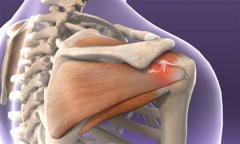 Rotator Cuff Repair Surgery | Proliance Orthopedic