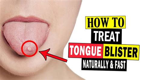 How to Get Rid of Tongue Blisters Naturally at Home || Home Remedies ...