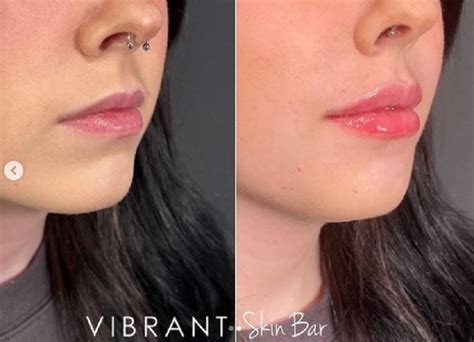 Juvederm Lip Filler: How It Works, Benefits, Results, Cost